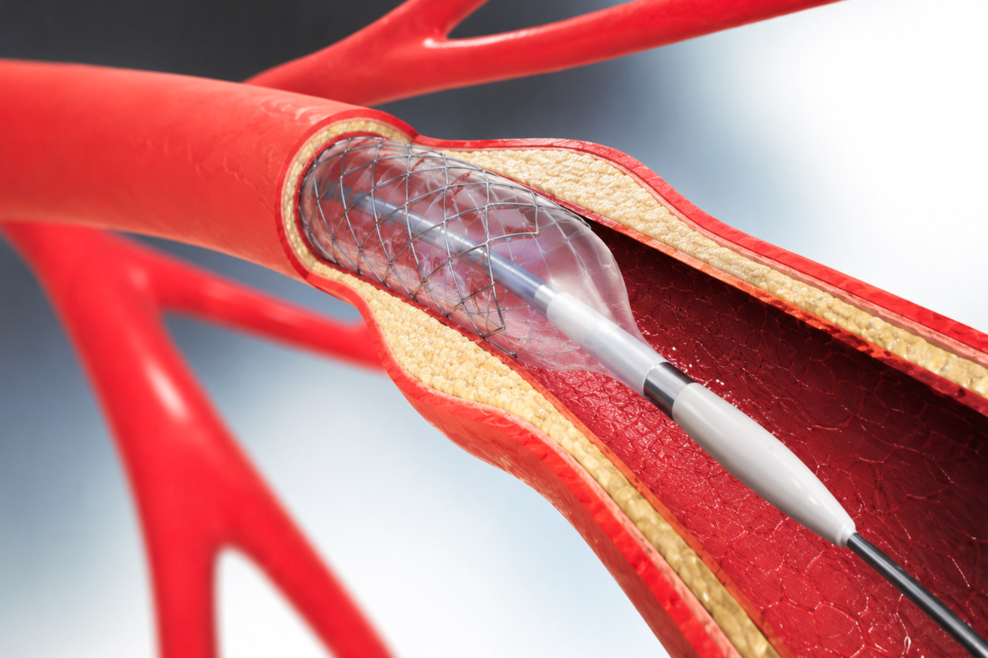 kardiologische-praxis-barth-dr-beug_INTERVENTIONELLE-KARDIOLOGIE